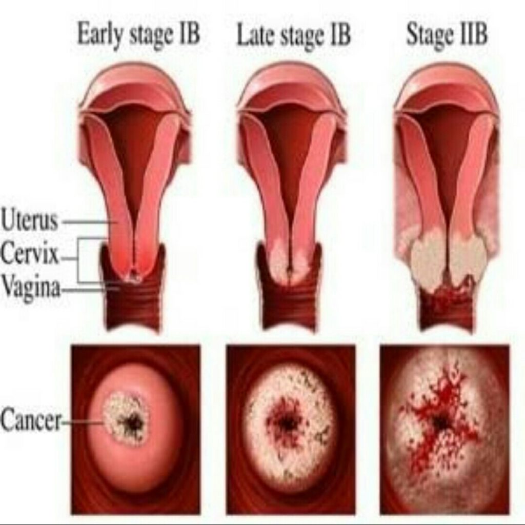 Kanker mulut rahim